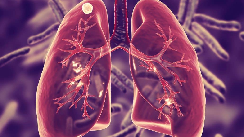 Tuberculosis deaths 2023