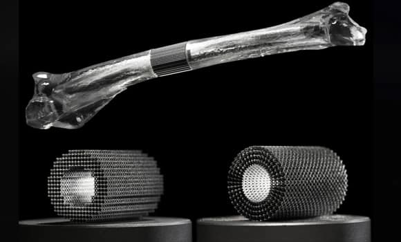 patient-specific bioresorbable implants